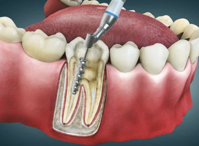 Root canal treatment at Grayson dental office